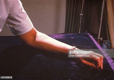 Skin Disease Pictures And Photos Getty Images
