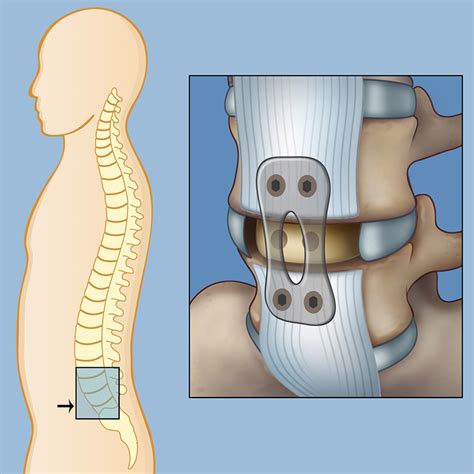 Alif For Spine Fusion Brain Spine Center