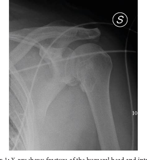 Acute Posterior Shoulder Dislocation With Reverse Hill Sachs Lesion Of