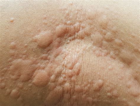 What Are Hives The Common Skin Condition That Gives You Itchy Red Bumps Evening Report
