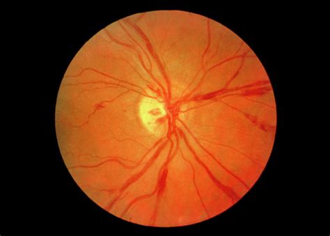 Ophthalmoscopy Of Eye Showing Retinal Vasculitis Photograph By Paul