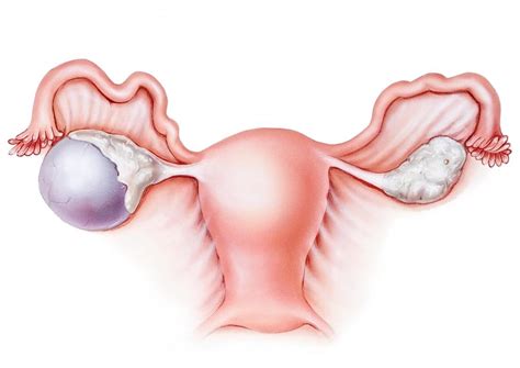 complex ovarian cyst symptoms risks pictures surgery