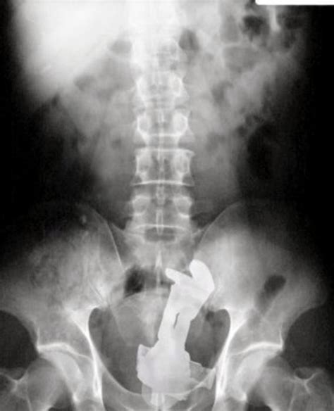 These Insane X Rays Will Make You Wonder How That Got There Others
