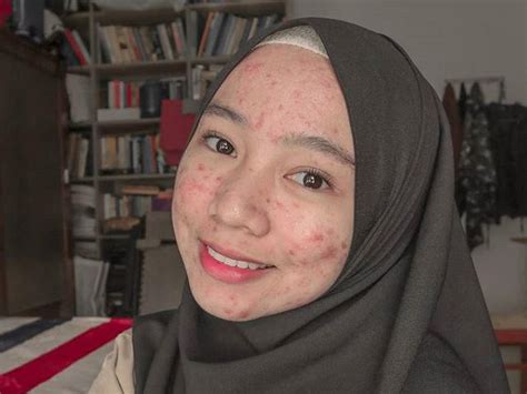 Viral Dipuji Netizen Hijabers Cianjur Yang Bangga Pamer Wajah Berjerawat