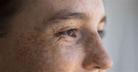 Hyperpigmentation Types Causes And Treatments Southeastern Dermatology