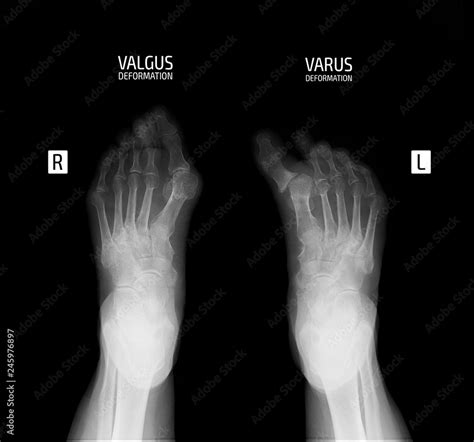 X Ray Of The Foot Varus And Valgus Deformity Of The 1st Finger Stock
