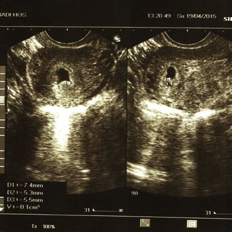 Pdf Chorionic Bump In First Trimester Sonography