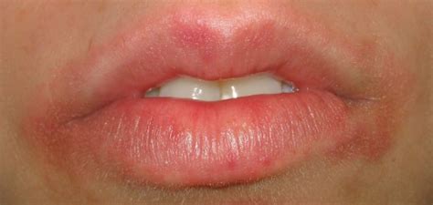 Rash Around Mouth—pictures Causes And Treatment