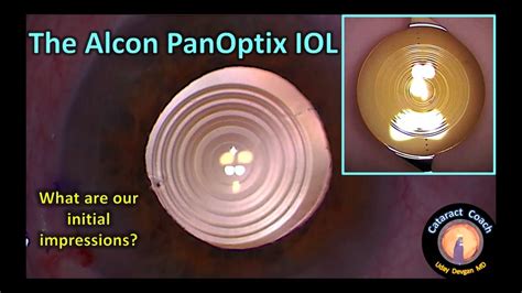 Review Of The Alcon Panoptix Lens For Cataract Surgery Youtube