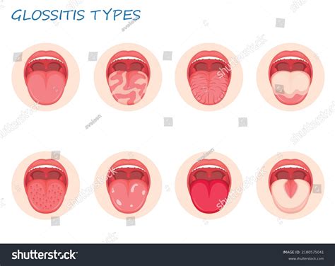 Types Glossitis Candidiasis Tongue Thrush Inflammation Stock Vector