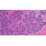 Basal Cell Carcinoma Of The Skin  MyPathologyReportca