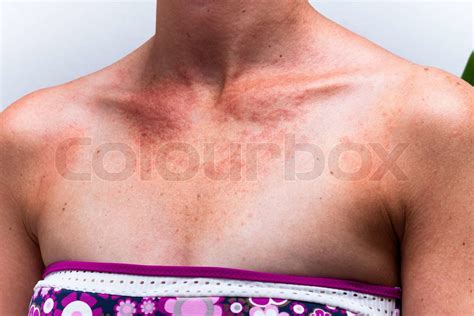 Sunburnt Female Skin With Sun Allergy Stock Image Colourbox