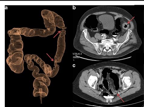Consequences Of Ct Colonography In Stenosing Colorectal Cancer