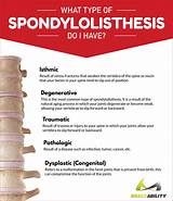 Images of Spondylolisthesis Physical Therapy Treatment