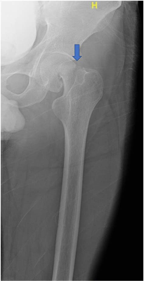 Left Femur X Ray Demonstrating The Right Femoral Neck Fracture The