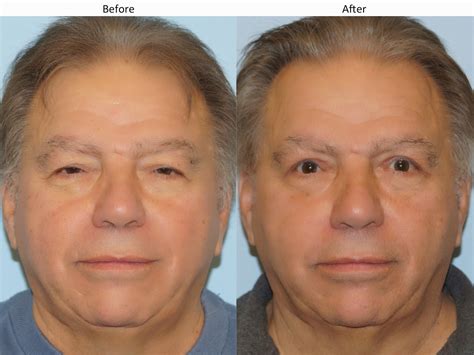 Droopy Eyelid Surgery Before And After Before And After