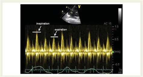 Normal Respiratory Variations Of The Tricuspid Inflow Velocities