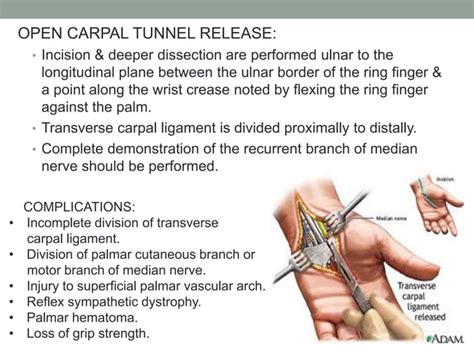 Entrapment Neuropathy Of The Upper Limb