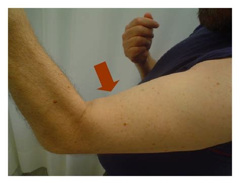 Figure 1 Nonoperative Treatment Of Distal Biceps Brachii
