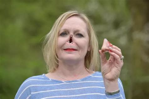 Mum Of Two Whose Nose Completely Rotted Away Has Life Changing
