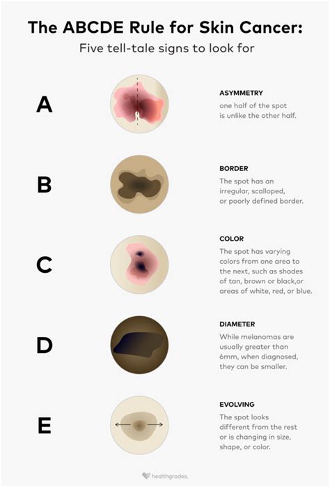 Abcdes Of Skin Cancer Melanoma Symptoms