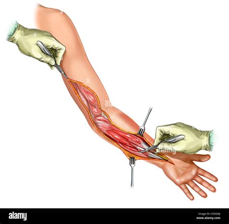 Fasciotomy Of Forearm Hi Res Stock Photography And Images Alamy