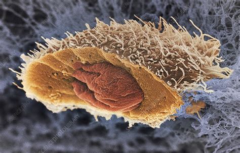 Oral Squamous Cell Carcinoma Sem Stock Image C0456286 Science