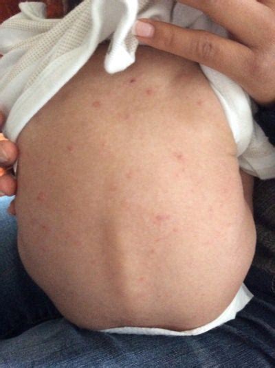 Christina and her husband when christina began feeling uncomfortable itching all over her body in the third trimester of her complications for babies from icp can be severe. I have a baby that has a rash all over his face, and body ...
