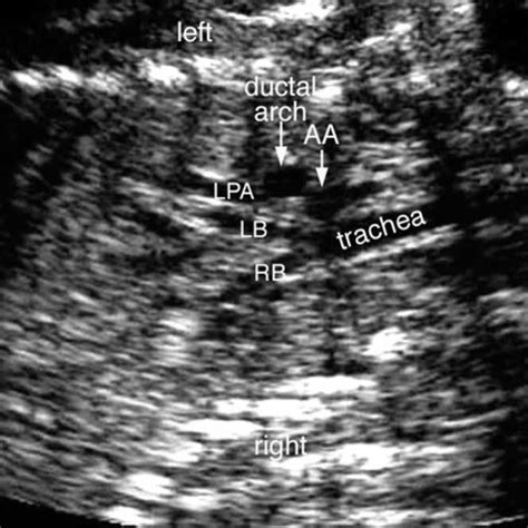 Fetal Sonographic Diagnosis Of Aortic Arch Anomalies Yoo 2003