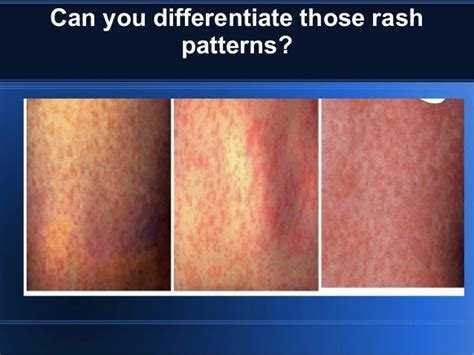 rash differential diagnosis of infectious diseases