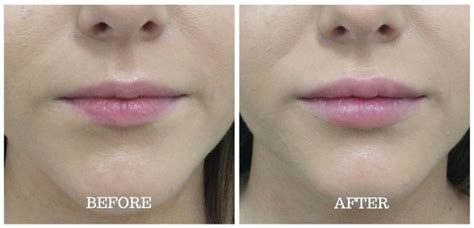 Lip Injections Before And After Dermal Cosmetics 2022