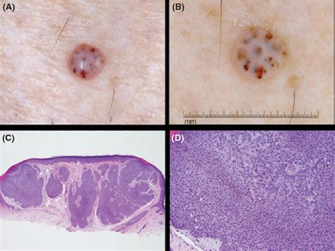 Figure 1 From Dermoscopic Findings In Biopsy‐proven Poromas Semantic