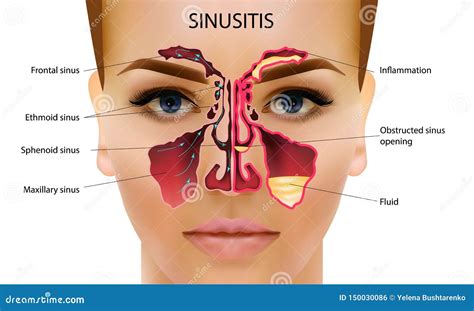 Sinusitis Illustrazione Nasale Di Infiammazione E Sana Del Seno Di