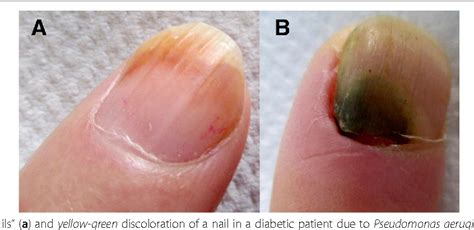 Transient Yellow Discoloration Of The Nails For Differential Diagnosis