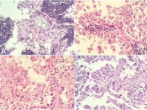 Side By Side Histopathological Comparison Between The Virchow Node And