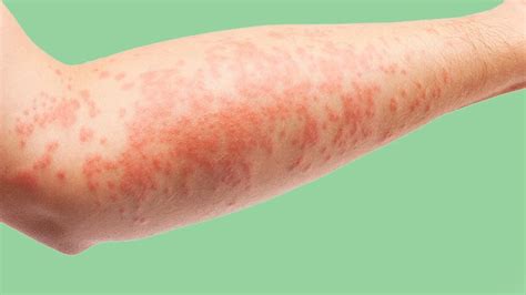 Eczema Atopic Dermatitis Symptoms Treatment Causes More