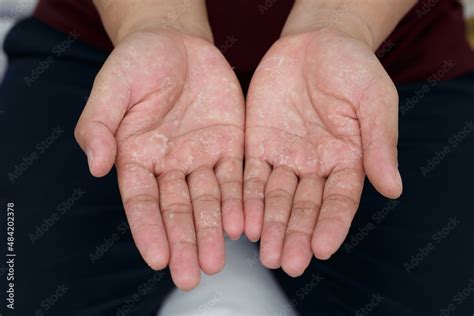 Dry Hands Peeling Skin On Hand And Fingers Air Allergy Chemical