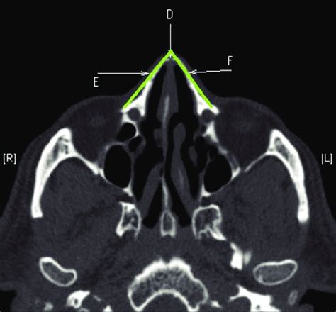 What does the nasal bones articulate wi… Axial computed tomography scan of the face. D: Mid nasal ...