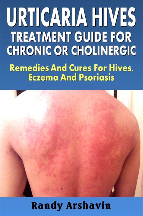 Urticaria Hives Treatment Guide For Chronic Or Cholinergic Remedies