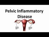 Home Remedies Pelvic Inflammatory Disease Images