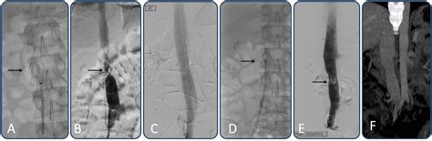 Cureus Effectiveness And Safety Of Laser Assisted Removal Of Inferior