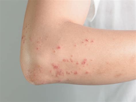 Hives The Severely Itchy Red Rash Healthy Living
