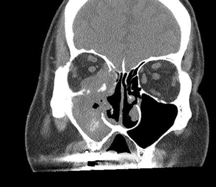 Acute Invasive Fungal Sinusitis Radiology Reference Article