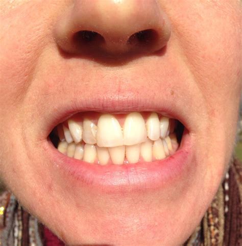 A means of saving a dead tooth. Heal A Dead Tooth With Essential Oils — Modern Hippie