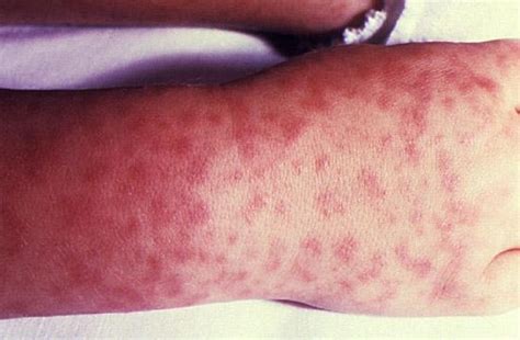 Rash On The Wrist Causes Diagnosis And Treatment