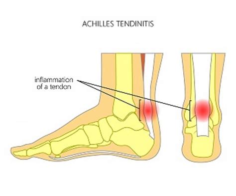 What Is Achilles Tendonitis Foot And Ankle Center Of Illinois Podiatrists