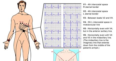 A Quick Guide To Ecg Ivline