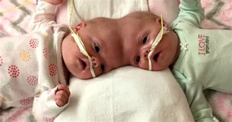 Amazing Story About The Conjoined Twins Connected At The Head Will Fill