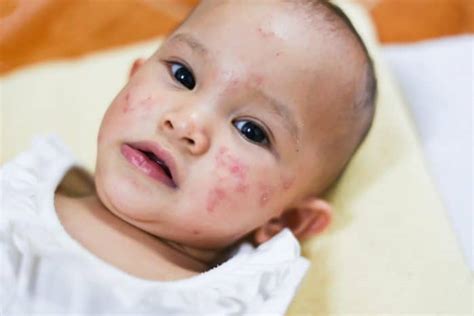 Ia terjadi dari kutu kudis yang bertelur pada kulit. 4 Penyakit yang menyebabkan benjolan kecil di kulit bayi