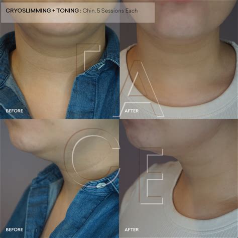 Cryoskin Before And After Pictures — Face